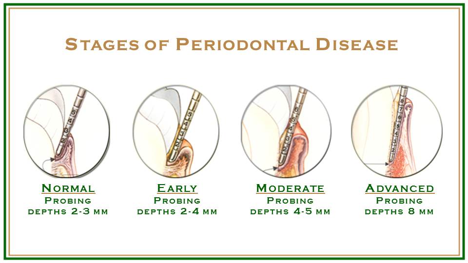 Periodontal (Gum) Disease