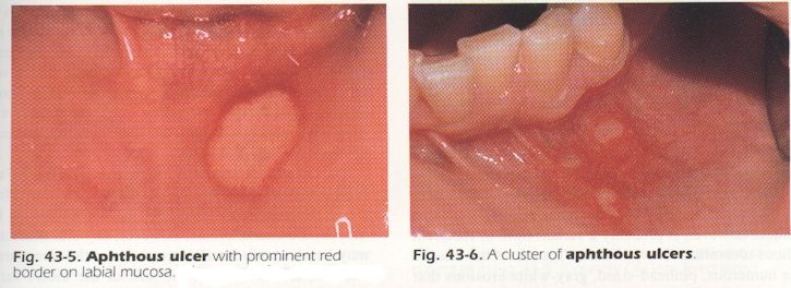 Apthous Ulcers occur in movable mouth tissues