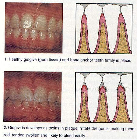 Gingivitis ...note there is no bone loss