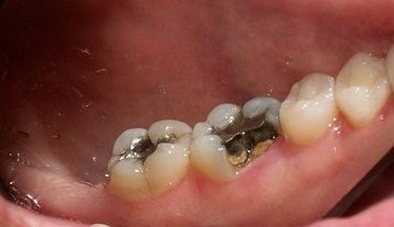 Linthicum Dentist | Linthicum dental Crowns | MD